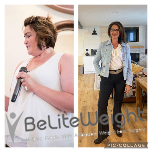 Weight Loss Surgery Before And After